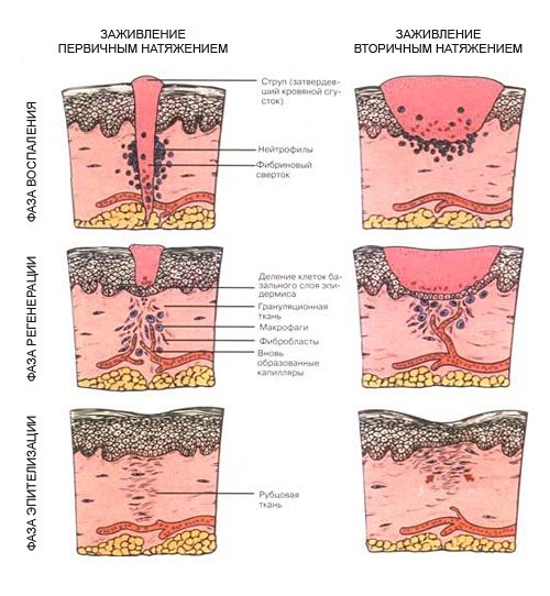 Фазы заживления ран
