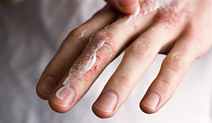 Препарат Эплан для лечения повреждений кожи