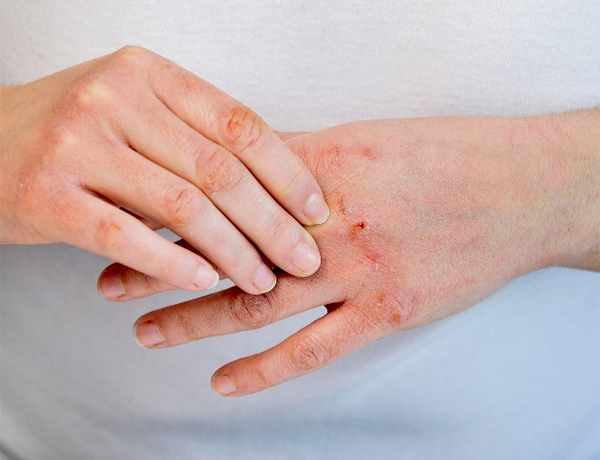 Препарат Эплан для лечения повреждений кожи