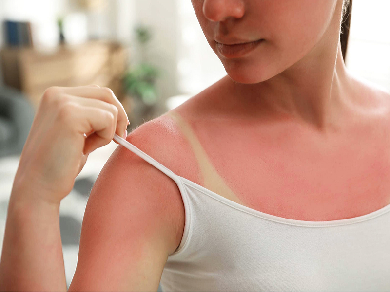 Препарат Эплан для лечения солнечного ожога